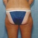 Liposuction and VASERLipo Before & After Patient #993