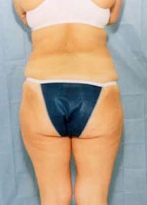 Liposuction and VASERLipo Before & After Patient #990