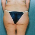 Liposuction and VASERLipo Before & After Patient #990