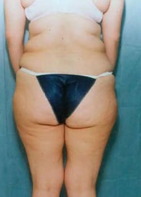 Liposuction and VASERLipo Before & After Patient #990