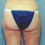Liposuction and VASERLipo Before & After Patient #989