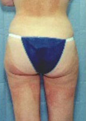 Liposuction and VASERLipo Before & After Patient #989