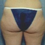 Liposuction and VASERLipo Before & After Patient #989