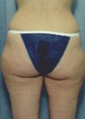 Liposuction and VASERLipo Before & After Patient #989