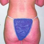Liposuction and VASERLipo Before & After Patient #986