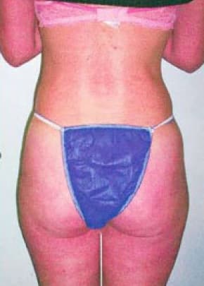 Liposuction and VASERLipo Before & After Patient #986