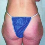 Liposuction and VASERLipo Before & After Patient #986