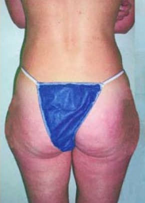 Liposuction and VASERLipo Before & After Patient #986