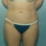 Liposuction and VASERLipo Before & After Patient #985