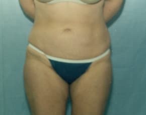 Liposuction and VASERLipo Before & After Patient #985
