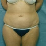 Liposuction and VASERLipo Before & After Patient #985