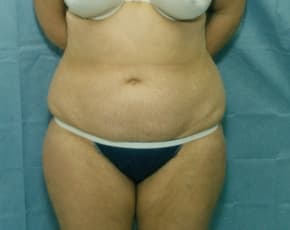 Liposuction and VASERLipo Before & After Patient #985