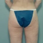 Liposuction and VASERLipo Before & After Patient #984