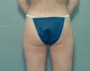 Liposuction and VASERLipo Before & After Patient #984