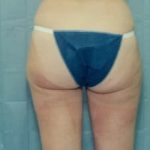Liposuction and VASERLipo Before & After Patient #984
