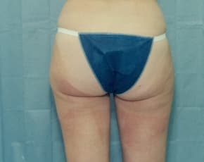 Liposuction and VASERLipo Before & After Patient #984