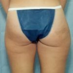 Liposuction and VASERLipo Before & After Patient #983