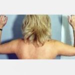 Liposuction and VASERLipo Before & After Patient #982