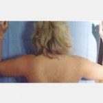 Liposuction and VASERLipo Before & After Patient #982