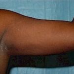 Liposuction and VASERLipo Before & After Patient #981