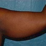 Liposuction and VASERLipo Before & After Patient #981