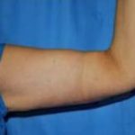 Liposuction and VASERLipo Before & After Patient #875