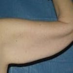 Liposuction and VASERLipo Before & After Patient #875