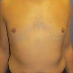 Male Breast Reduction Before & After Patient #863