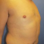 Male Breast Reduction Before & After Patient #863