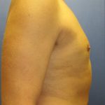 Male Breast Reduction Before & After Patient #863