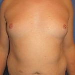 Male Breast Reduction Before & After Patient #863