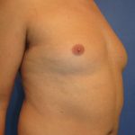 Male Breast Reduction Before & After Patient #863