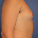 Male Breast Reduction Before & After Patient #863