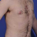 Male Breast Reduction Before & After Patient #862
