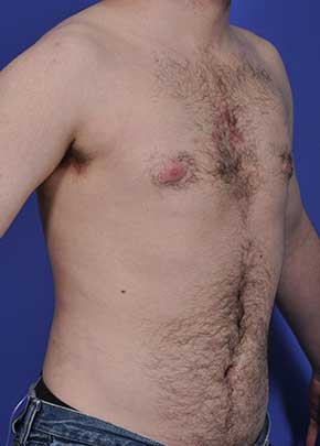 Male Breast Reduction Before & After Patient #862