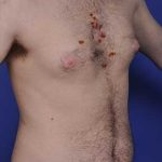 Male Breast Reduction Before & After Patient #862