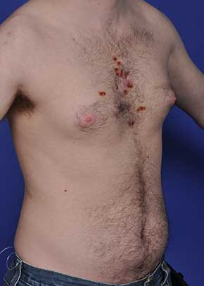 Male Breast Reduction Before & After Patient #862
