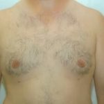 Male Breast Reduction Before & After Patient #861