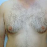 Male Breast Reduction Before & After Patient #861