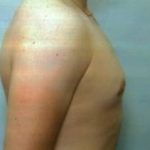 Male Breast Reduction Before & After Patient #860