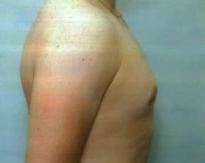 Male Breast Reduction Before & After Patient #860
