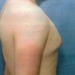 Male Breast Reduction Before & After Patient #860