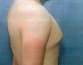 Male Breast Reduction Before & After Patient #860