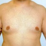 Male Breast Reduction Before & After Patient #859