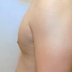 Male Breast Reduction Before & After Patient #858