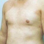 Male Breast Reduction Before & After Patient #857