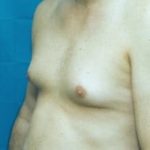Male Breast Reduction Before & After Patient #857