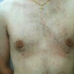 Male Breast Reduction Before & After Patient #856