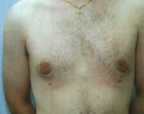 Male Breast Reduction Before & After Patient #856