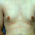 Male Breast Reduction Before & After Patient #856